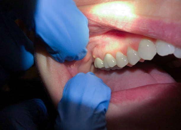 Best Emergency Dentist for Lost Fillings or Crowns in North College Hill, OH